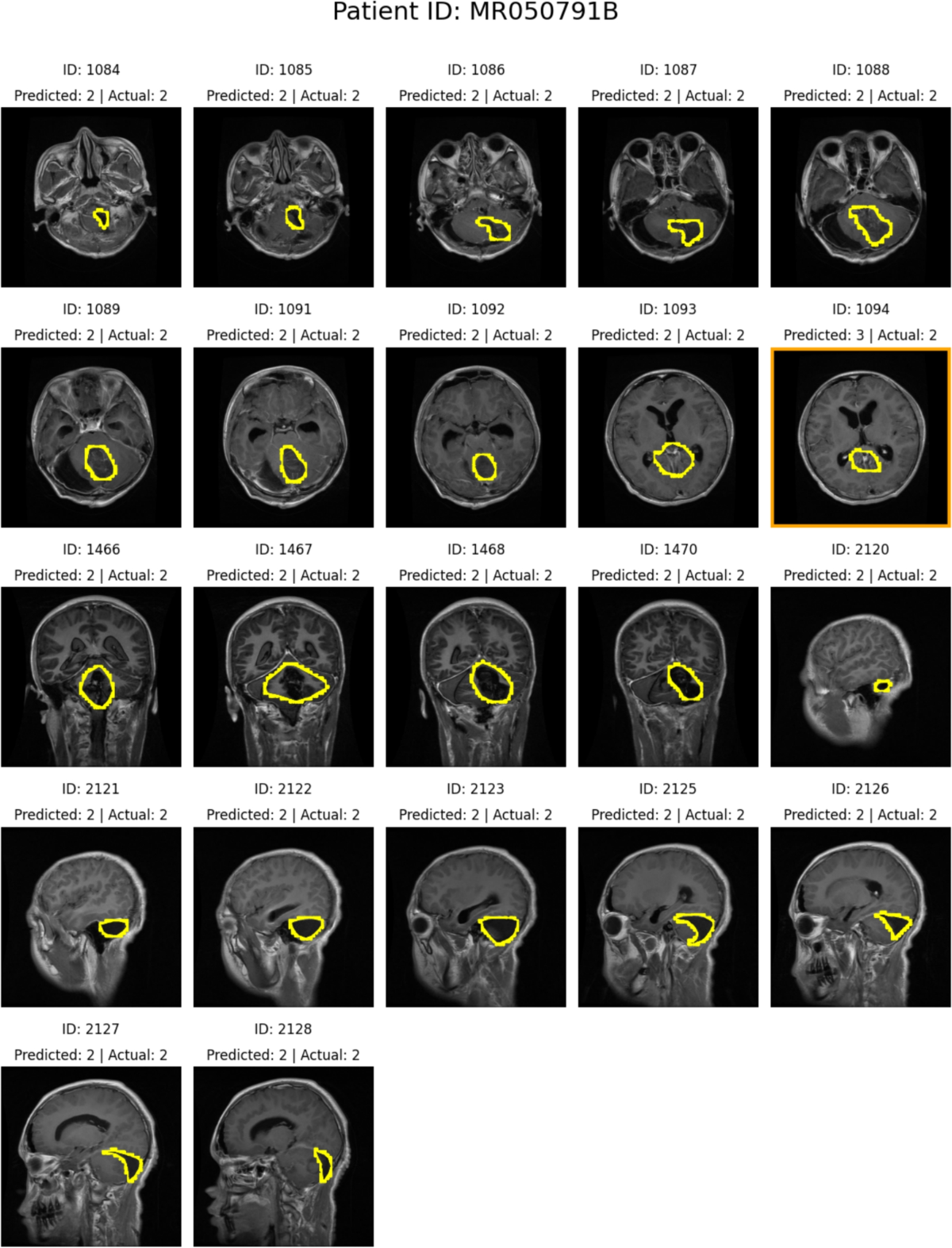 Fuzzy Decision Trees for Explainable Brain Tumor Classification: A  Comparative Study with Deep Neural Networks and Classical Binary Decision  Trees | Information Systems Frontiers | Springer Nature Link
