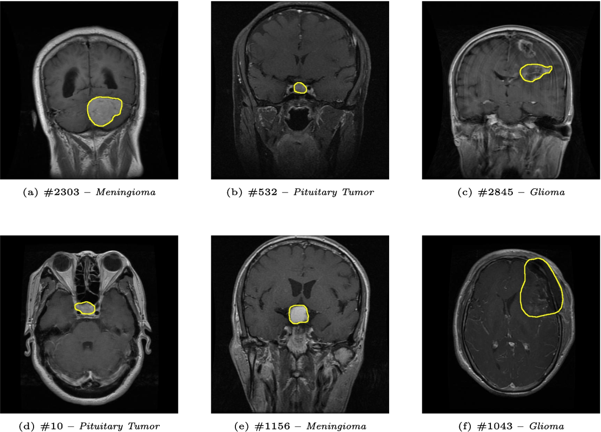 Fuzzy Decision Trees for Explainable Brain Tumor Classification: A  Comparative Study with Deep Neural Networks and Classical Binary Decision  Trees | Information Systems Frontiers | Springer Nature Link