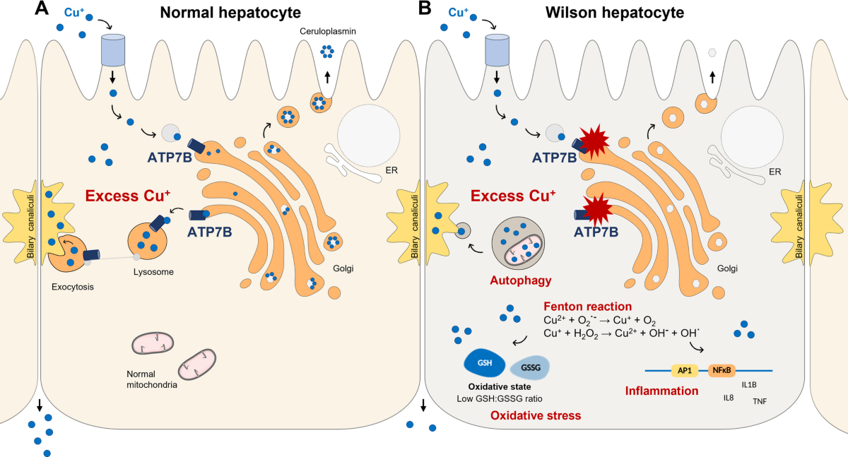 ghk-cu contraindications wilson's disease High copper levels induce oxidative stress and inflammatory processes in a  cell culture model of Wilson's disease | Molecular and Cellular  Biochemistry