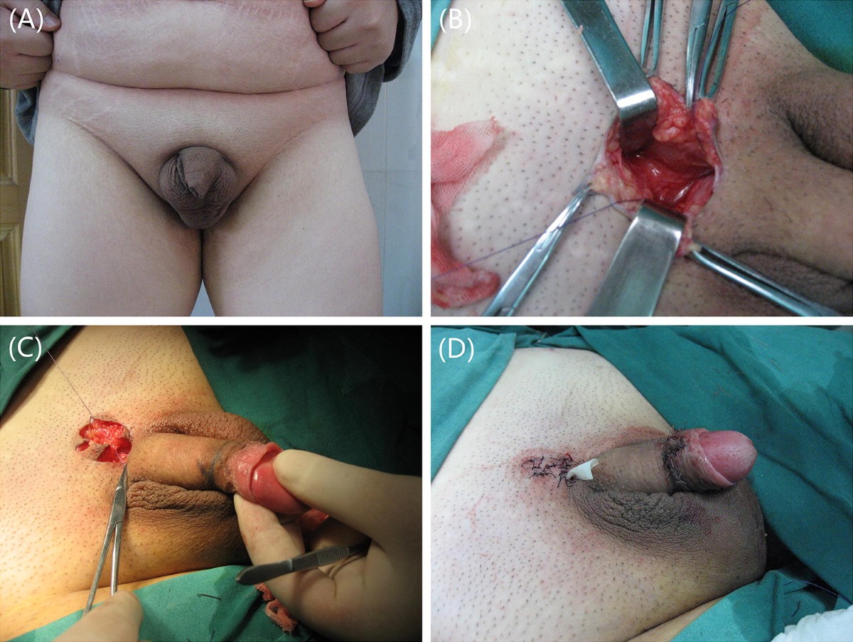 buried penis pictures 