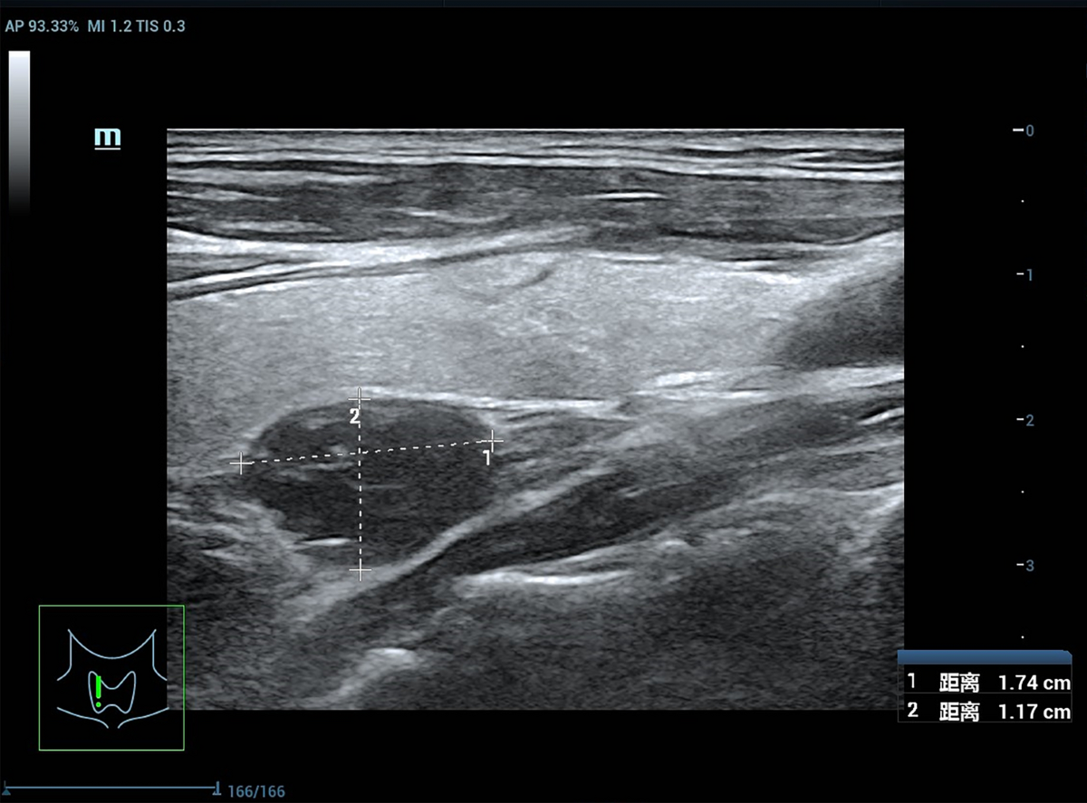 Correlation between parathyroid volume and calcium and phosphorus  metabolism in maintenance hemodialysis patients based on Doppler ultrasound  technology | International Urology and Nephrology | Springer Nature Link