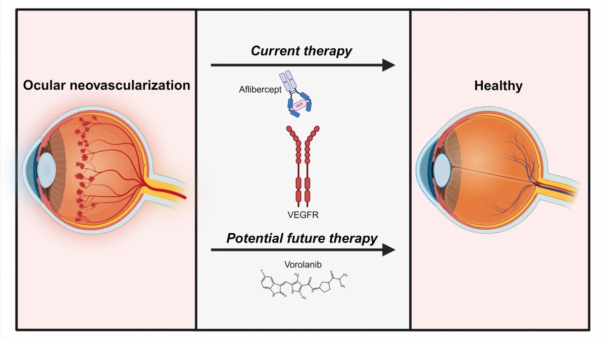 Recent advances in treating age-related macular degeneration and 