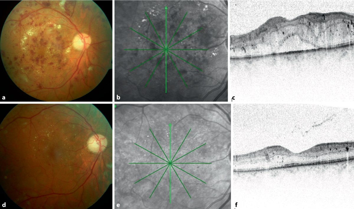 Diabetische Retinopathie Epidemiologie, Stadien, Diagnostik ...