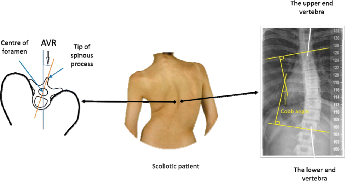 A semi-automatic 3D ultrasound reconstruction method to assess the true severity of adolescent idiopathic scoliosis | Medical & Biological Engineering & Computing