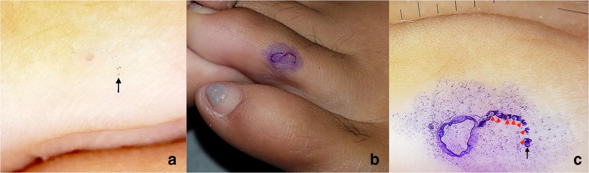 The Burrow Ink Test: a Simple Method to Improve the Diagnosis of 