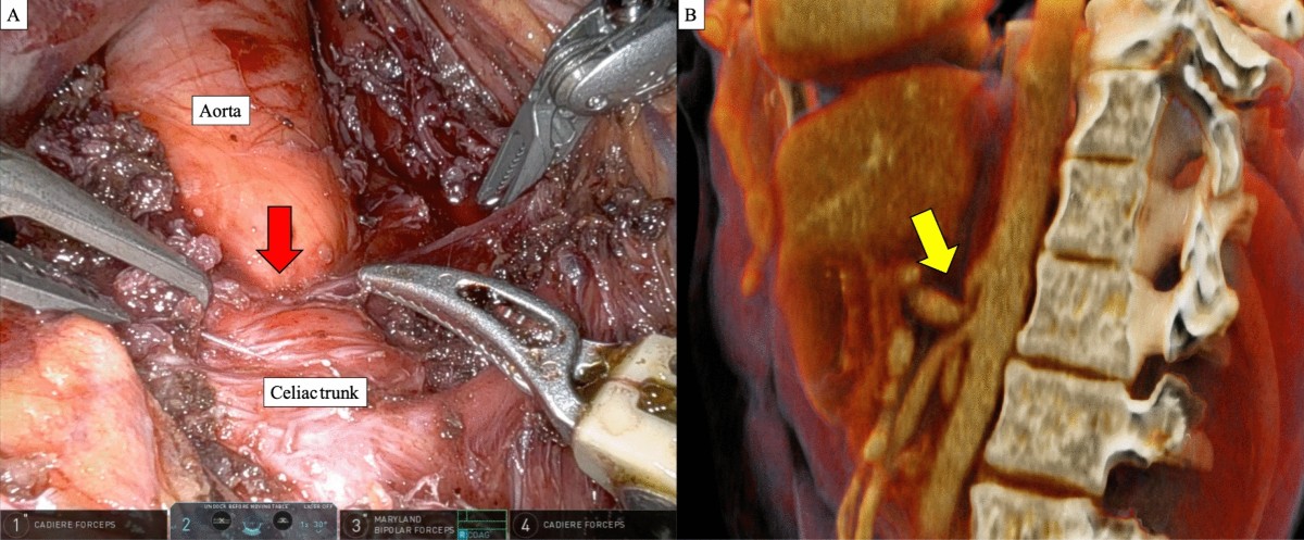 Robot-assisted vascular surgery: literature review, clinical applications, and future perspectives | Journal of Robotic Surgery | Springer Nature Link