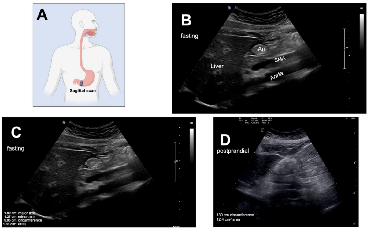 glp-1 pancreatitis lawyer in kentucky law firm Risk of pancreatic cancer associated with receptor agonist therapy GLP-1 Agonists and Pancreatitis Risk  glp-1 pancreatitis law firm in