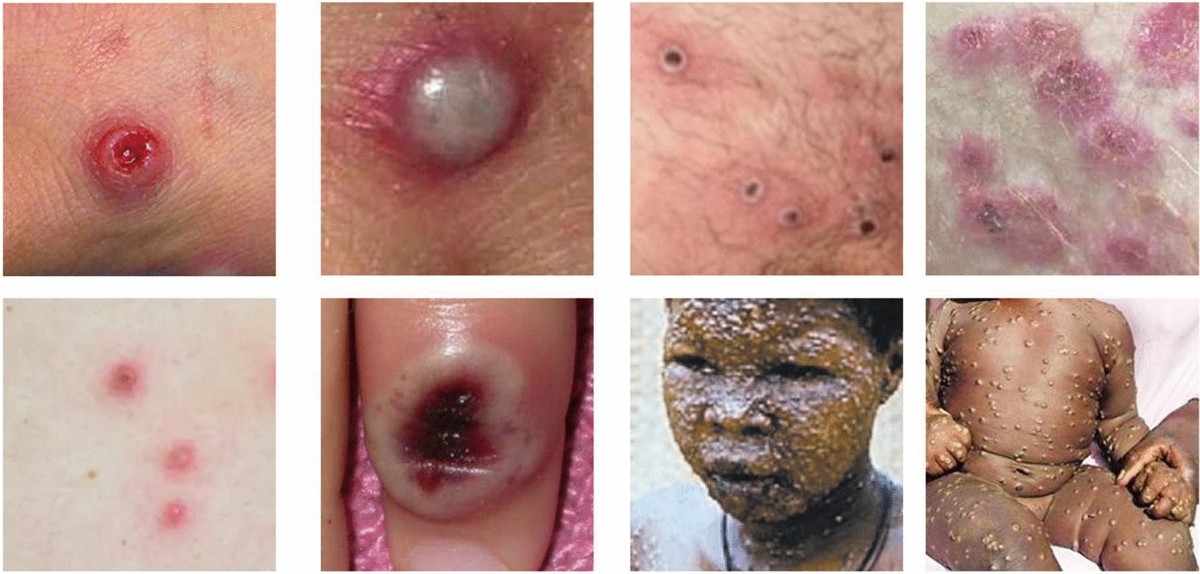 AI-Based Approaches for the Diagnosis of Mpox: Challenges and Future Prospects | Archives of Computational Methods in Engineering