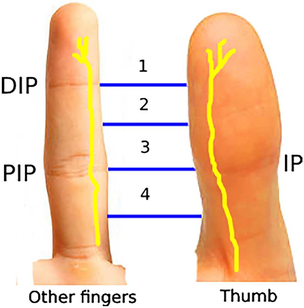 Digital nerve injury: to repair or not? | Irish Journal of Medical Science  (1971 -) | Springer Nature Link
