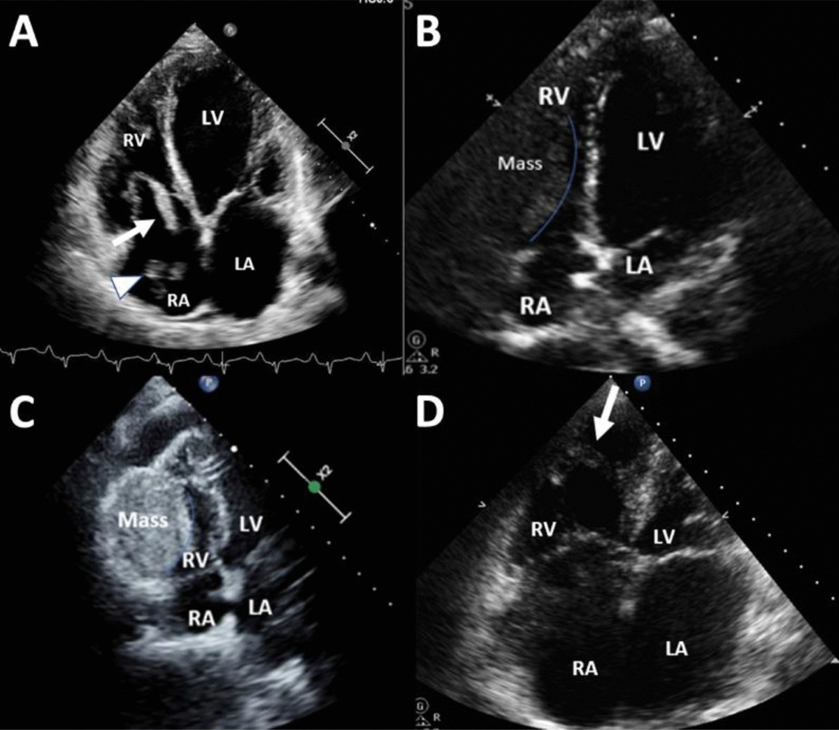 Echocardiographic Evaluation of Cardiac Masses | Current Cardiology Reports  | Springer Nature Link