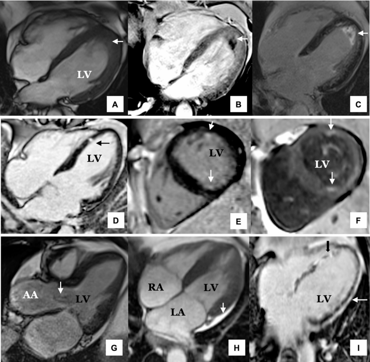 Cardiac Involvement in Eosinophilic Granulomatosis with Polyangiitis |  Current Cardiology Reports | Springer Nature Link