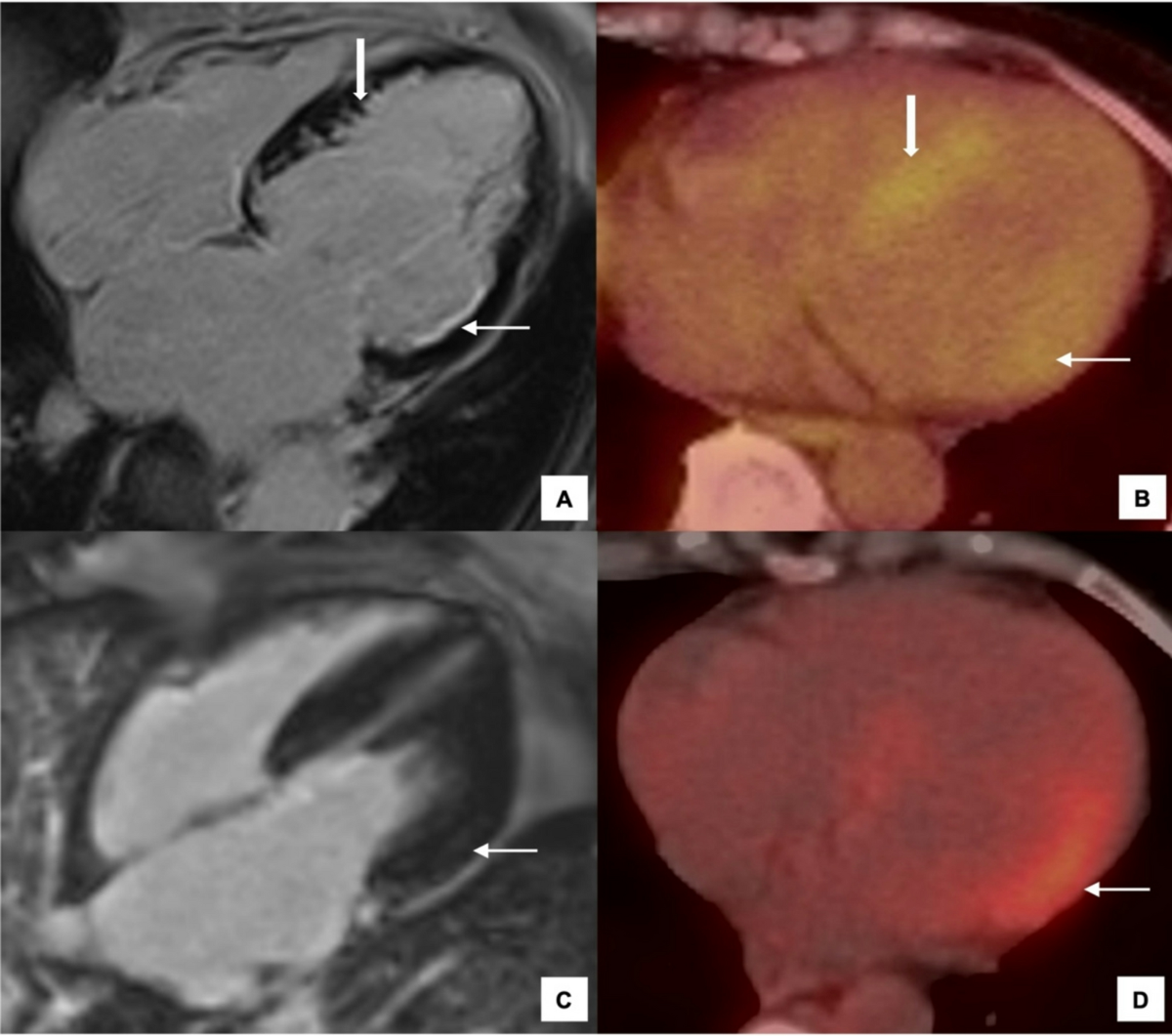 Cardiac Involvement in Eosinophilic Granulomatosis with Polyangiitis |  Current Cardiology Reports | Springer Nature Link
