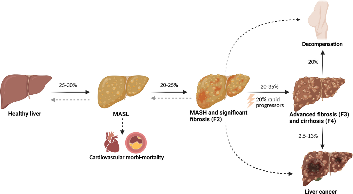 glp 1 cirrhosis GLP-1 and Glucagon Receptor Dual Agonists in the Management of Metabolic  Dysfunction-associated Steatotic Disease (MASLD) | Current Hepatology  Reports