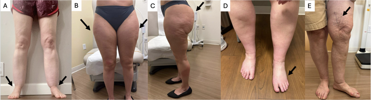 para que serve tirzepatide Compounded Tirzepatide With B6 (Pyridoxine)