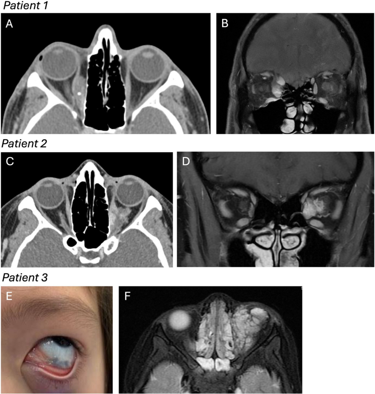 FULL TEXT - Orbital lymphangioma - International Journal of Case Reports  and Images (IJCRI), image size:1200x1261