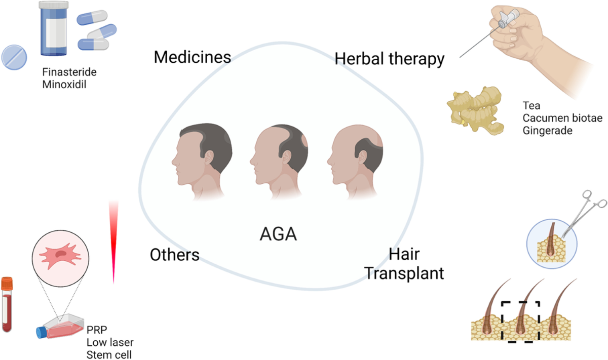 Cell Therapy for Androgenetic Alopecia: Elixir or Trick? | Stem Cell  Reviews and Reports