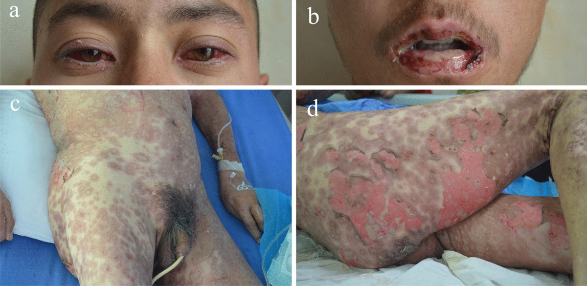 glutathione iv allergic reactions burn Current Perspectives on Severe Drug Eruption | Clinical Reviews in Allergy  & Immunology