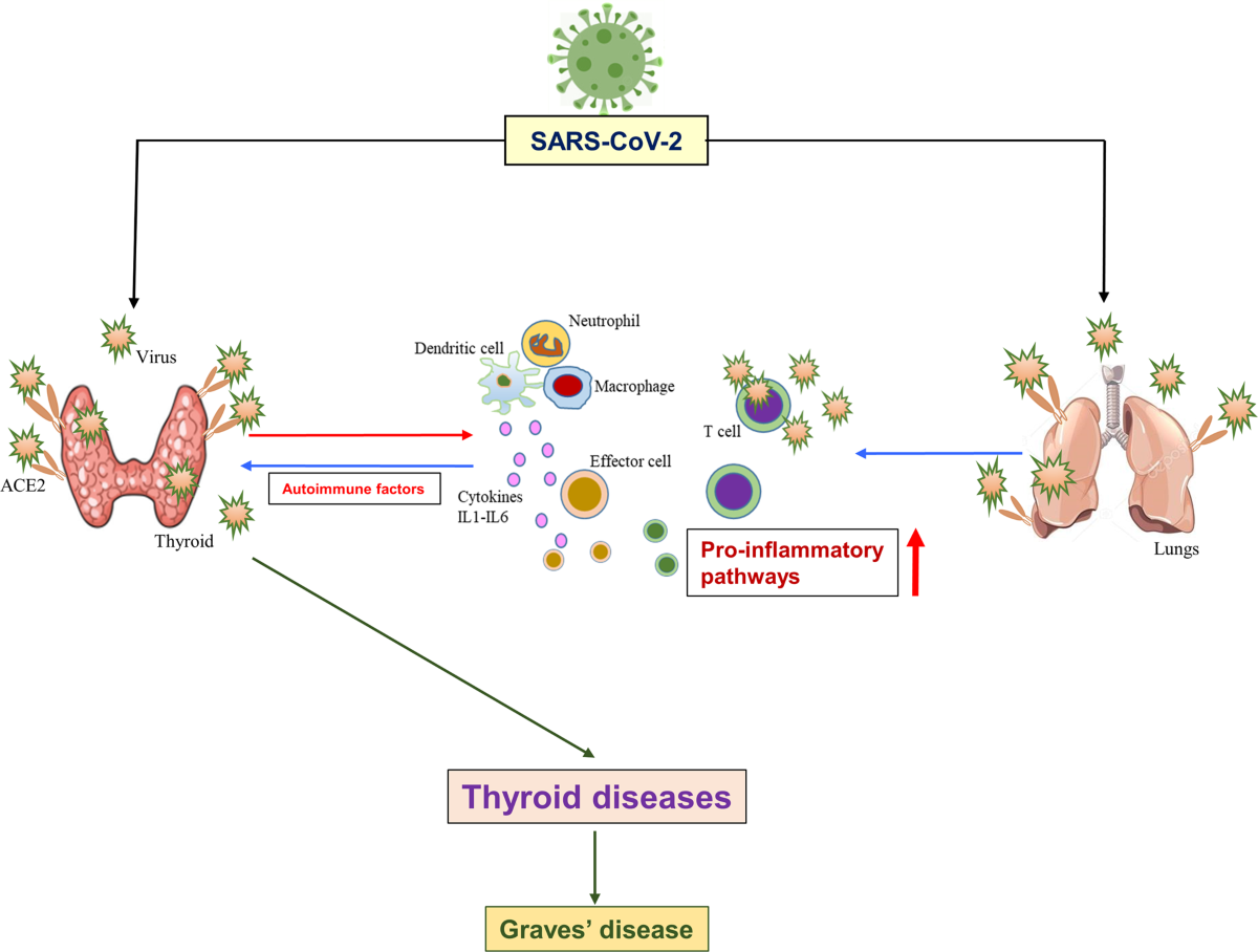 SARS-CoV-2 plays a pivotal role in inducing hyperthyroidism of Graves'  disease | Endocrine