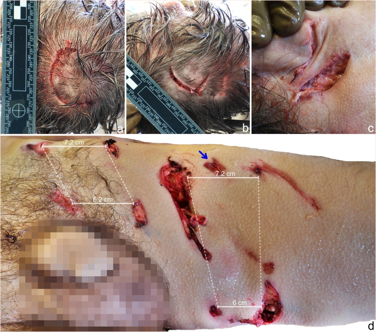 Claws and canines: injury patterns following European brown bear attacks |  Forensic Science, Medicine and Pathology, image size:1200x1059