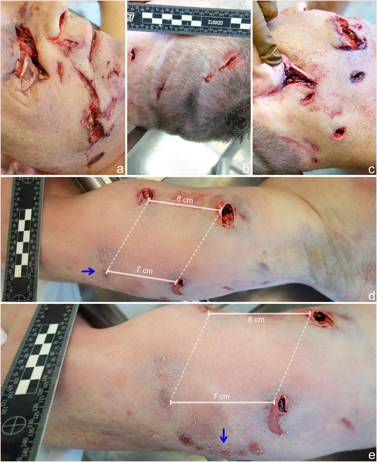 Claws and canines: injury patterns following European brown bear attacks |  Forensic Science, Medicine and Pathology, image size:1200x1471