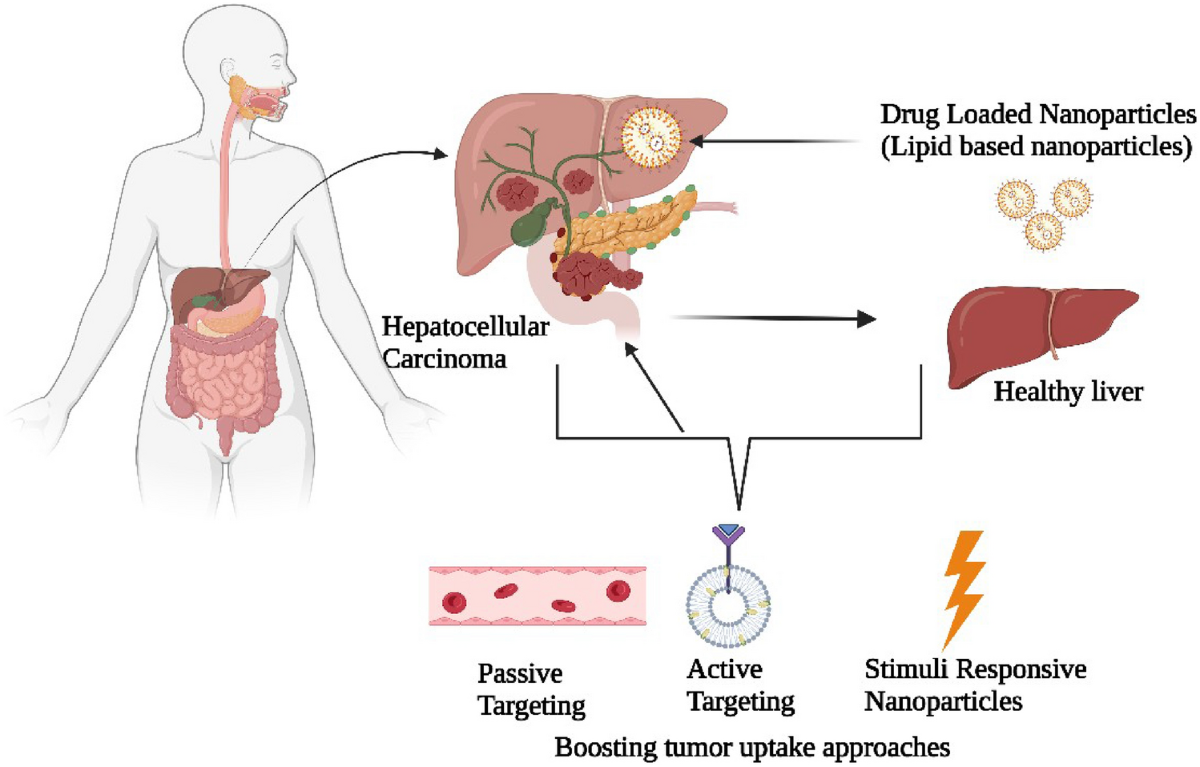sinha et al. 2018 eur j clin nutr liposomal glutathione Advanced therapeutics avenues in hepatocellular carcinoma: a novel paradigm  | Medical Oncology