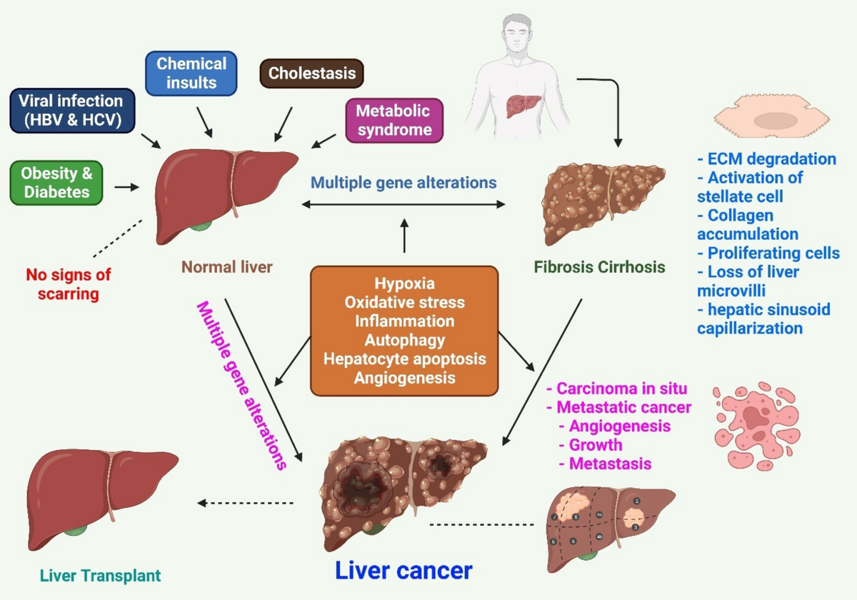 The advanced development of molecular targeted therapy for hepatocellular  carcinoma | Cancer Biology \u0026 Medicine, image size:1200x840