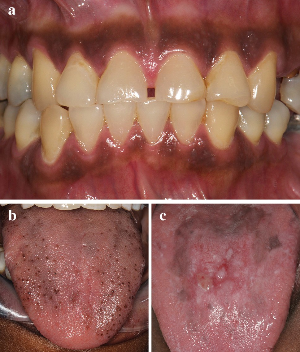 Black and Brown: Non-neoplastic Pigmentation of the Oral Mucosa | Head and  Neck Pathology