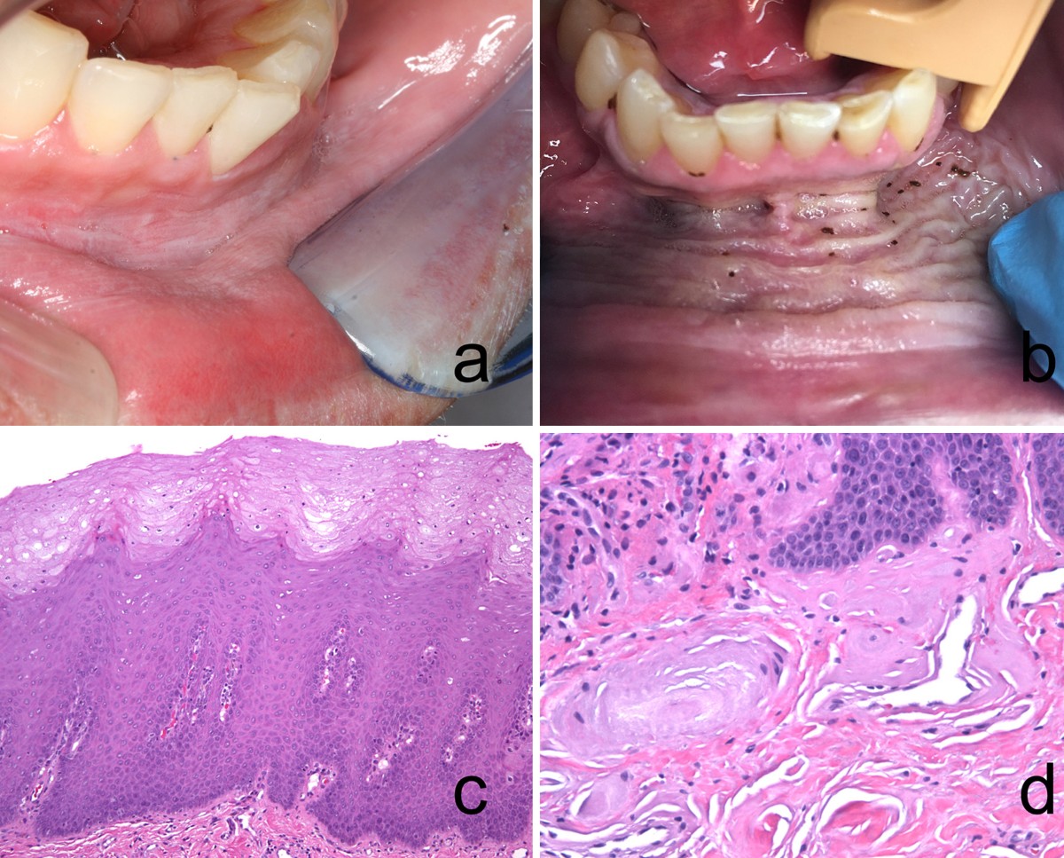 tobacco pouch keratosis Frictional Keratosis, Contact Keratosis and Smokeless Tobacco Keratosis:  Features of Reactive White Lesions of the Oral Mucosa | Head and Neck  Pathology