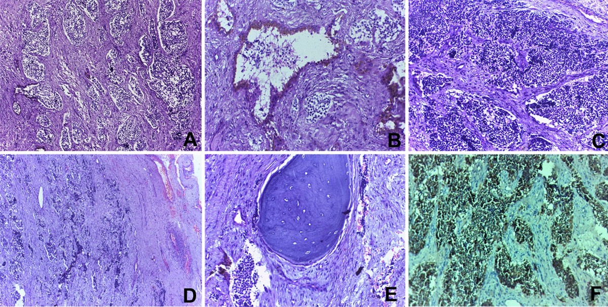 Melanotic Neuroectodermal Tumour of Infancy | Head and Neck Pathology