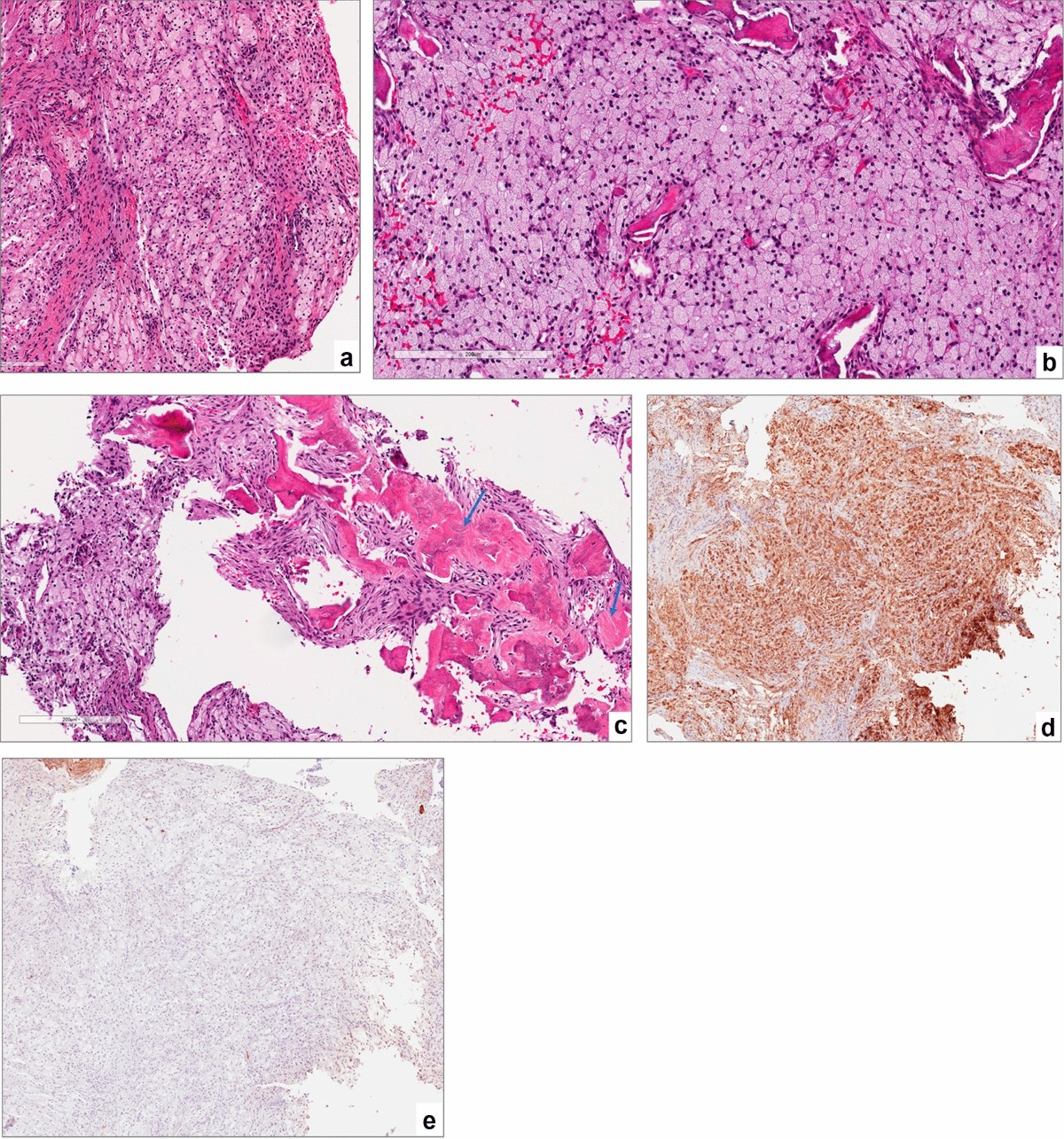 Xanthoma of the Jaw Bones: Cases Series and Review of Literature | Head and  Neck Pathology, image size:1200x1285