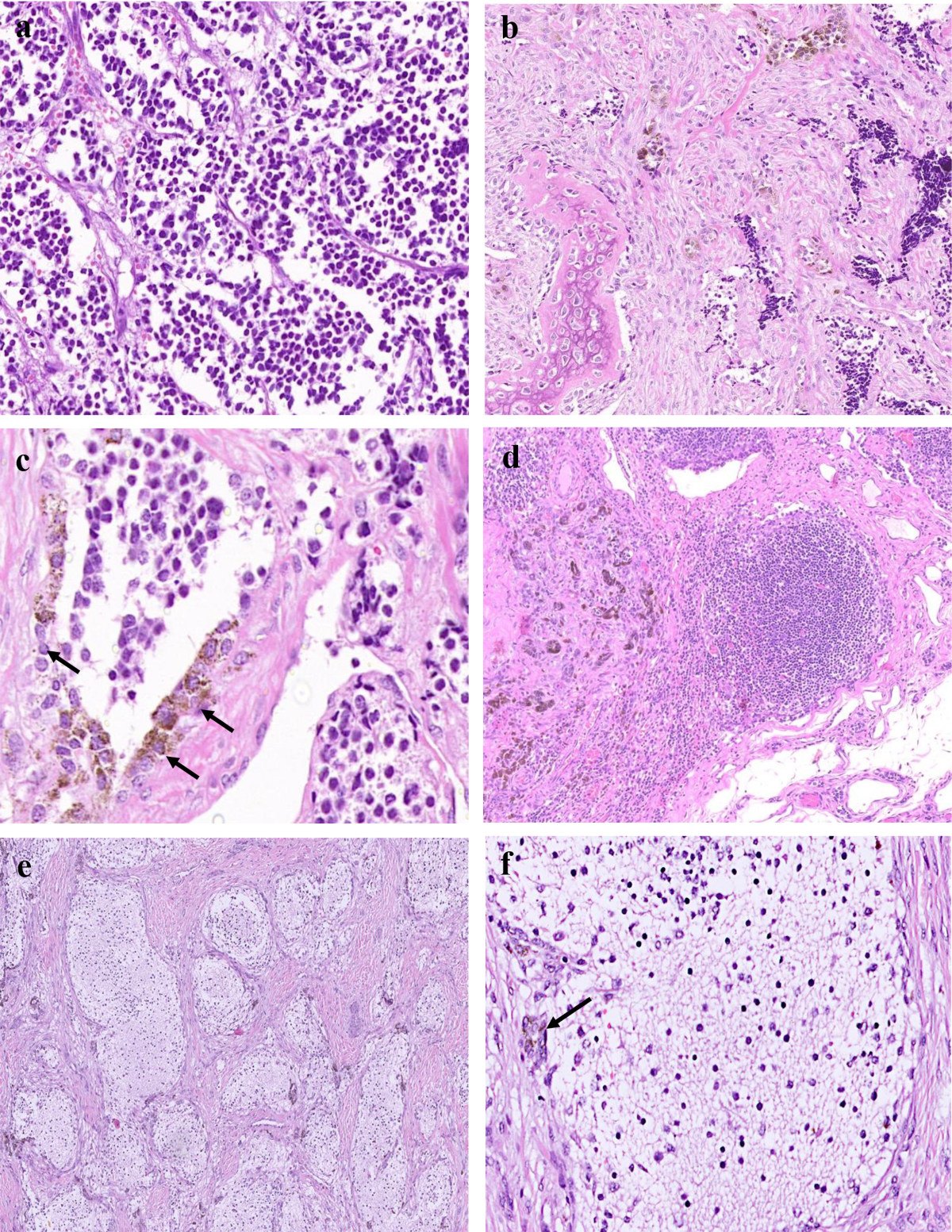Melanotic Neuroectodermal Tumor of Infancy: Clinicopathological Evaluation  of a 10-Year Consecutive Case Series from a Tertiary Cancer Center | Head  and Neck Pathology