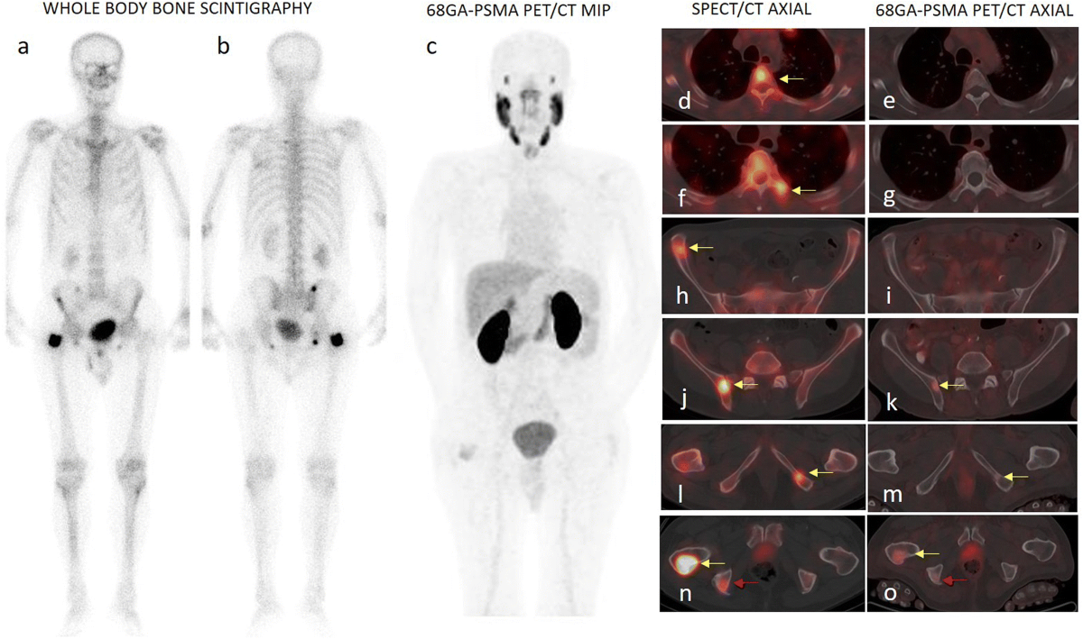 Does bone scintigraphy still have a role in the era of 68 Ga-PSMA PET/CT in prostate  cancer? | Annals of Nuclear Medicine, image size:1200x709