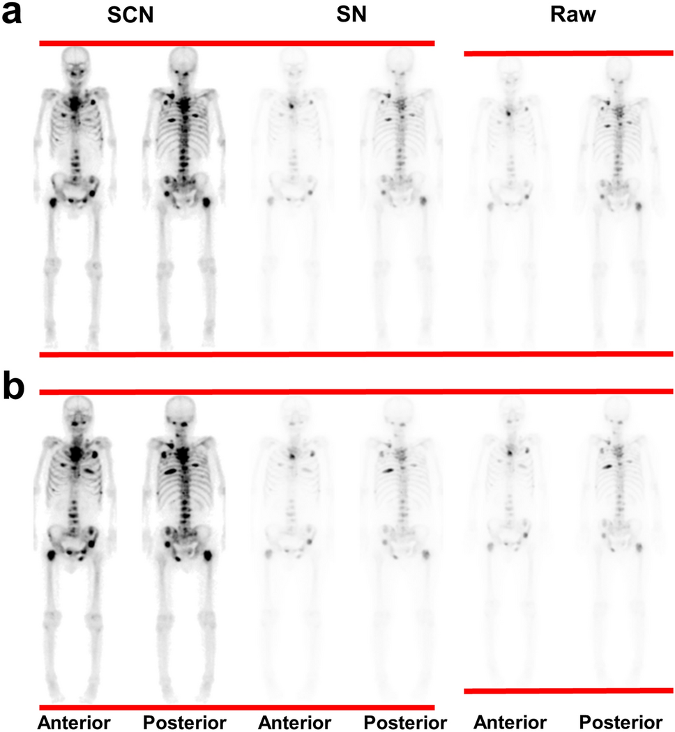 Performance of deep learning models for response evaluation on whole-body bone  scans in prostate cancer | Annals of Nuclear Medicine, image size:968x1051