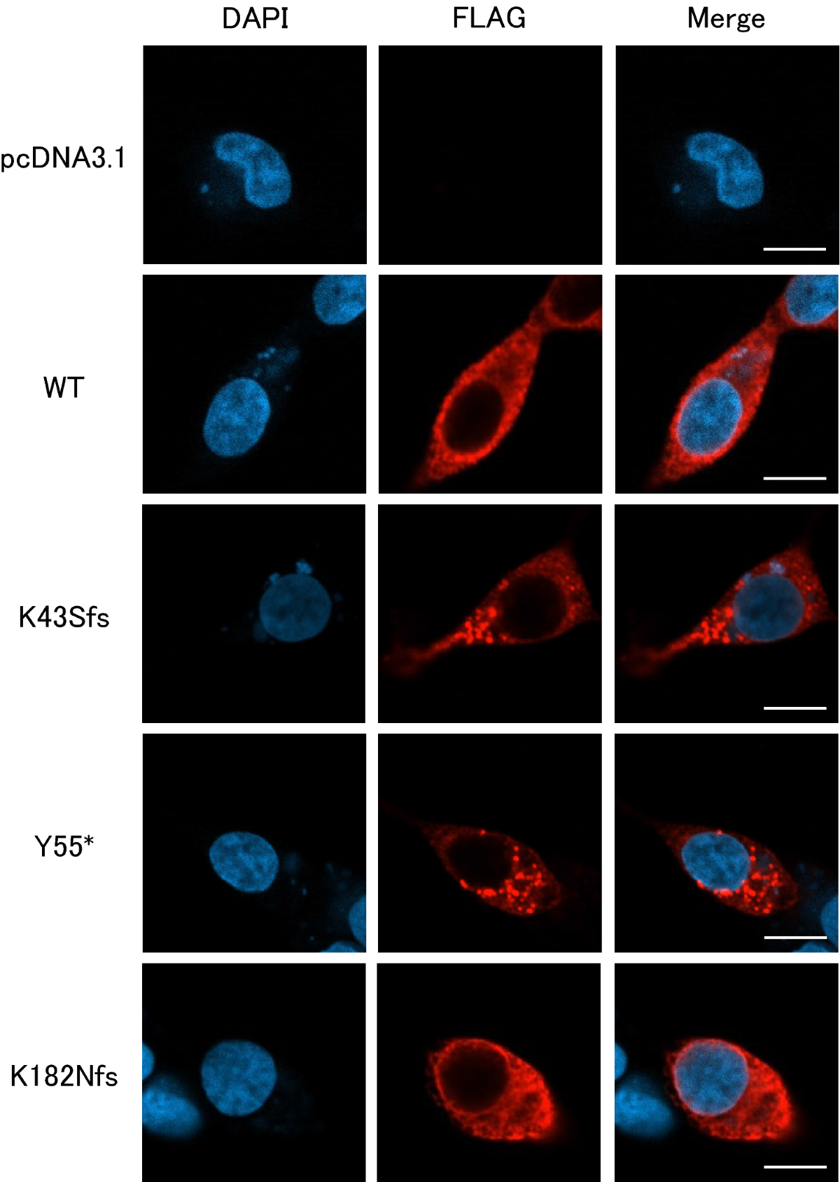Identification and functional analysis of three novel genetic variants resulting in premature termination codons in three unrelated patients with hereditary antithrombin deficiency | International Journal of Hematology identification-and-functional-analysis-of-three-novel-genetic-variants-resulting-in-premature-termination-codons-in-three-unrelated-patients-with-hereditary-antithrombin-deficiency-international-journal-of-hematology