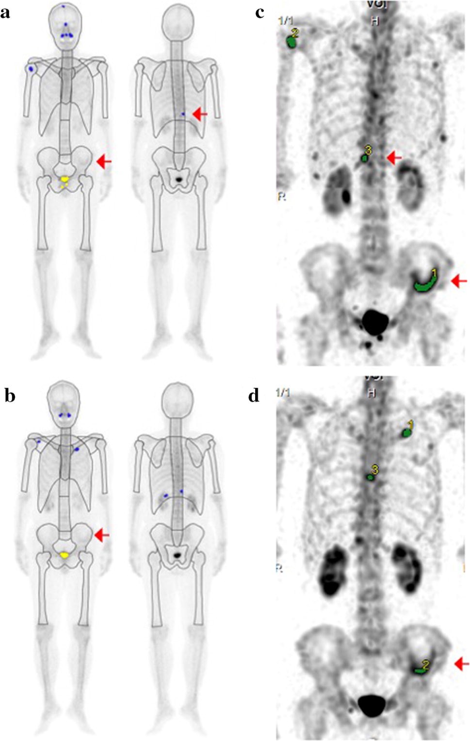 Widespread Blastic Bone Metastases from Prostate Cancer - Musculoskeletal  Radiology Case Studies - CTisus CT Scanning, image size:969x1527