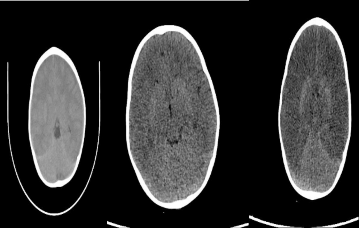 Fatal Late-Onset Presentation of Ornithine Transcarbamylase (OTC) Deficiency:  A Case Report Highlighting Diagnostic Challenges and Cerebral Complications  | Indian Journal of Clinical Biochemistry | Springer Nature Link