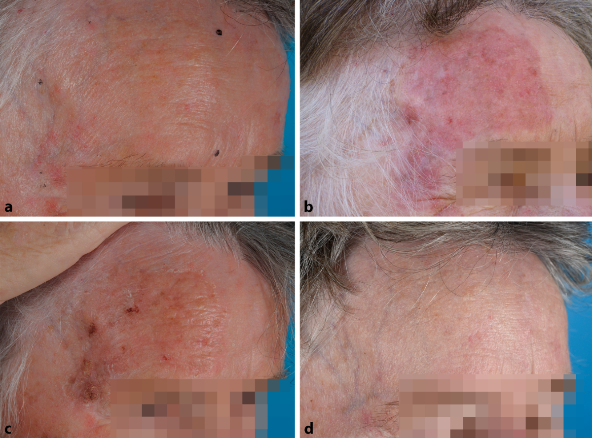 Photodynamische Therapie – aktuelle Trends | hautnah, image size:1200x889