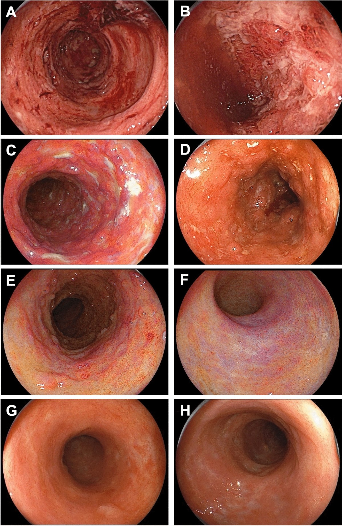 Biologic therapy for ulcerative colitis associated with immune thrombocytopenia | Clinical Journal of Gastroenterology