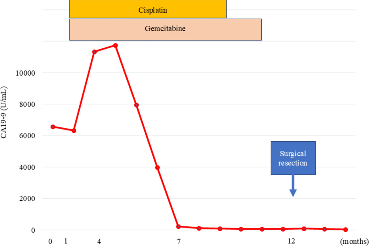 Pathological complete response following addition of durvalumab to  gemcitabine and cisplatin therapy for intrahepatic cholangiocarcinoma with  Lynch syndrome-associated mismatch repair deficiency | Clinical Journal of  Gastroenterology