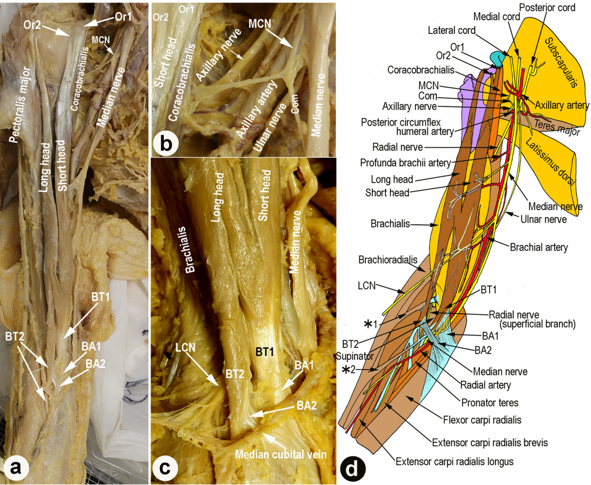 Bifurcated distal biceps brachii tendon coexisting with separated bicipital  aponeurosis: a complex variational case report | Anatomical Science  International, image size:1200x984