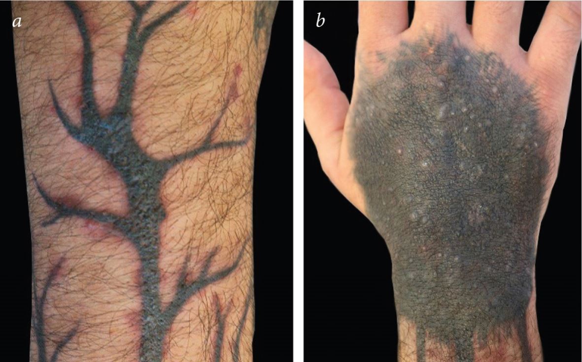 Pickel auf meinem Tattoo unter der Zweithaut? : r/tattooadvice, image size:1181x736