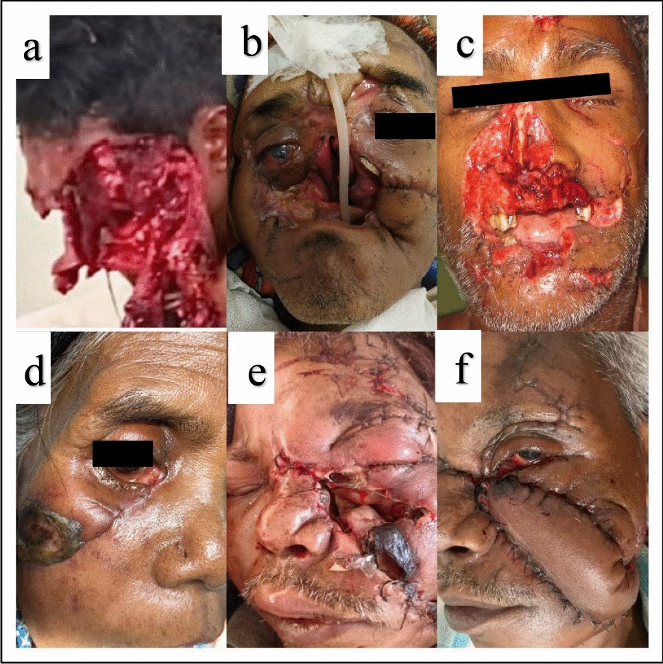 Bear Mauling Injuries in Maxillofacial Region: A Review of 30 victims from  Eastern India | Journal of Maxillofacial and Oral Surgery, image size:967x968