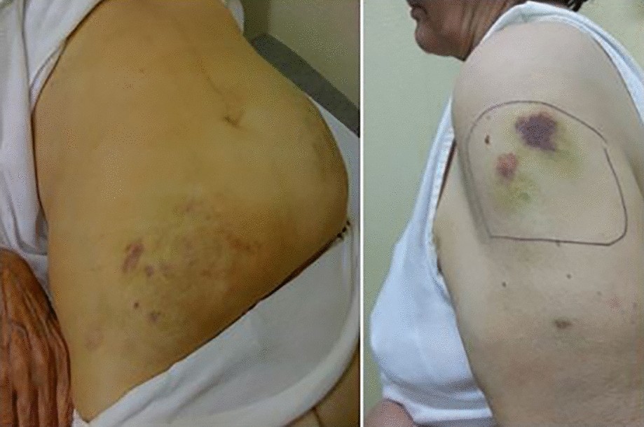 Bruising: A Neglected, Though Patient-Relevant Complication of Insulin  Injections Coming to Light from a Real-Life Nationwide Survey | Diabetes  Therapy | Springer Nature Link