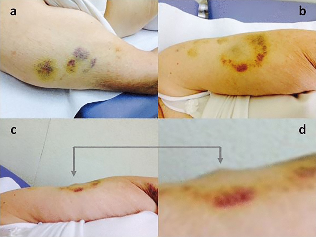 Bruising: A Neglected, Though Patient-Relevant Complication of Insulin  Injections Coming to Light from a Real-Life Nationwide Survey | Diabetes  Therapy
