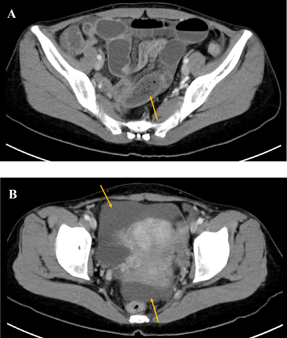 can glp 1 cause bowel obstruction Food-induced small bowel obstruction observed in a patient with  inappropriate use of semaglutide | Diabetology International