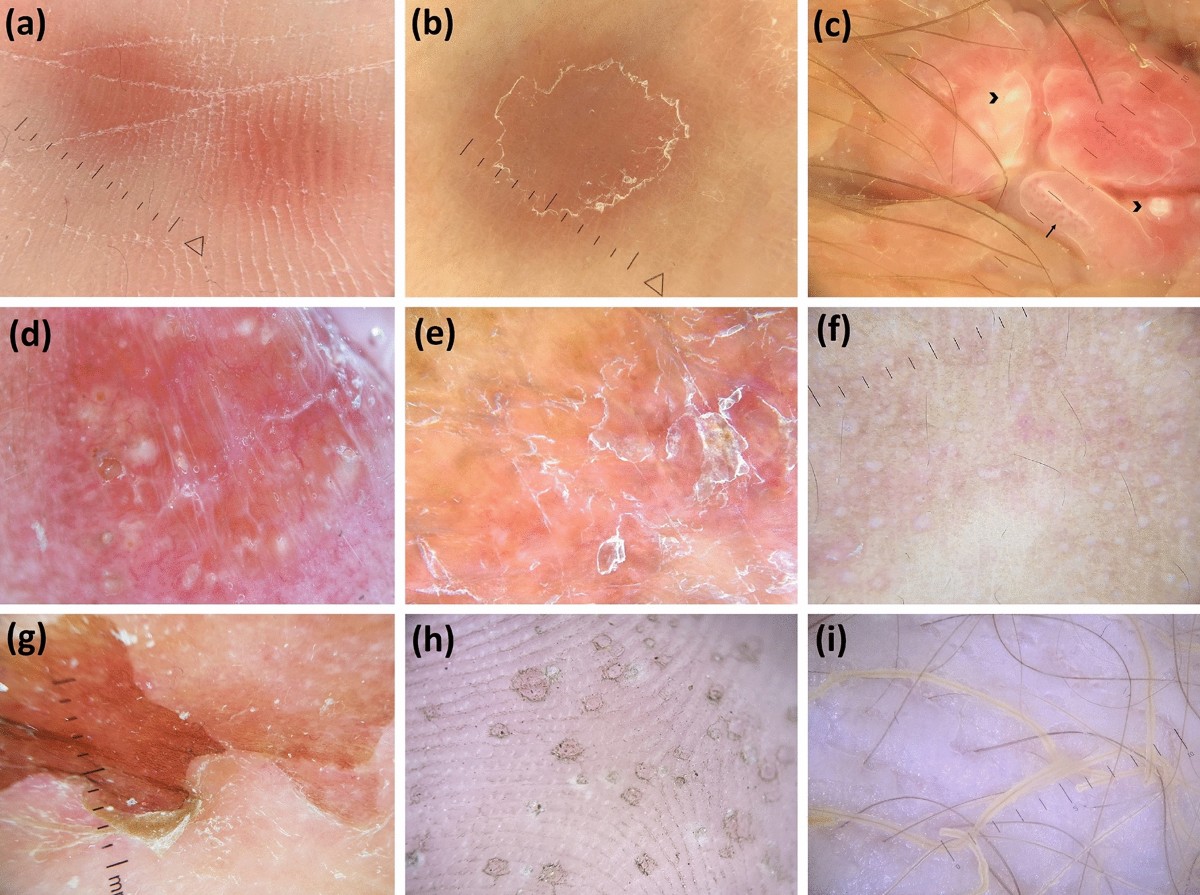 Dermoscopy of Bacterial, Viral, and Fungal Skin Infections: A Systematic  Review of the Literature | Dermatology and Therapy