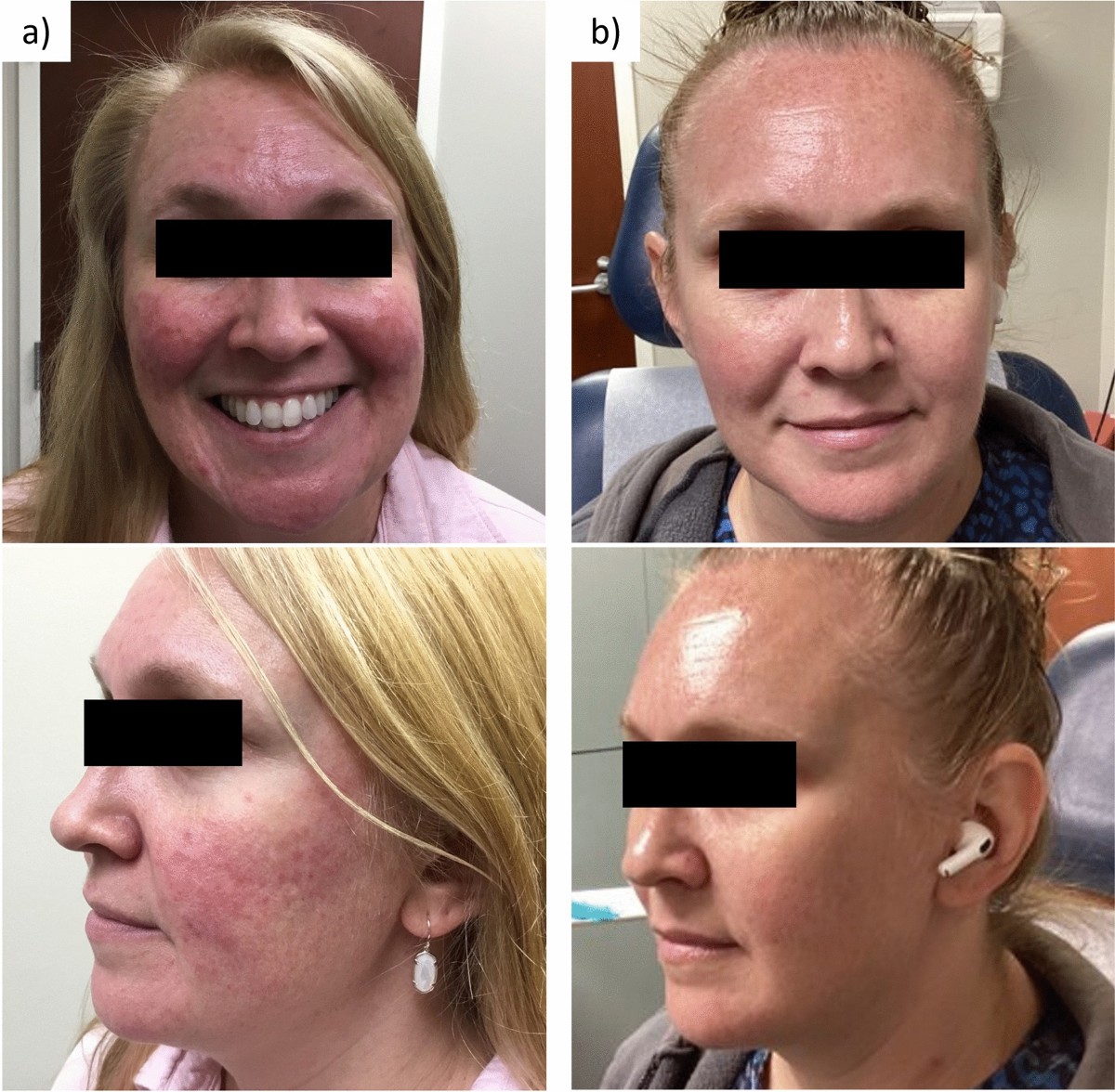 melanotan cured my rosacea I accidentally undid years of skin work and didnt realize it until it was too late., At the beginning of November, I started taking 2 and honestly?, I loved it., tan deepened A Review of the Diagnostic