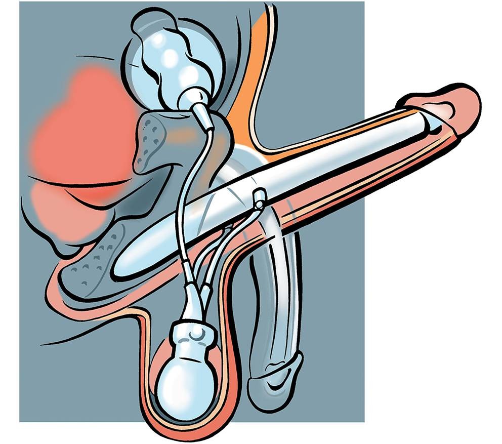 De erectieprothese voor de behandeling van erectiele disfunctie:  herintroductie in Nederland | Tijdschrift voor Urologie