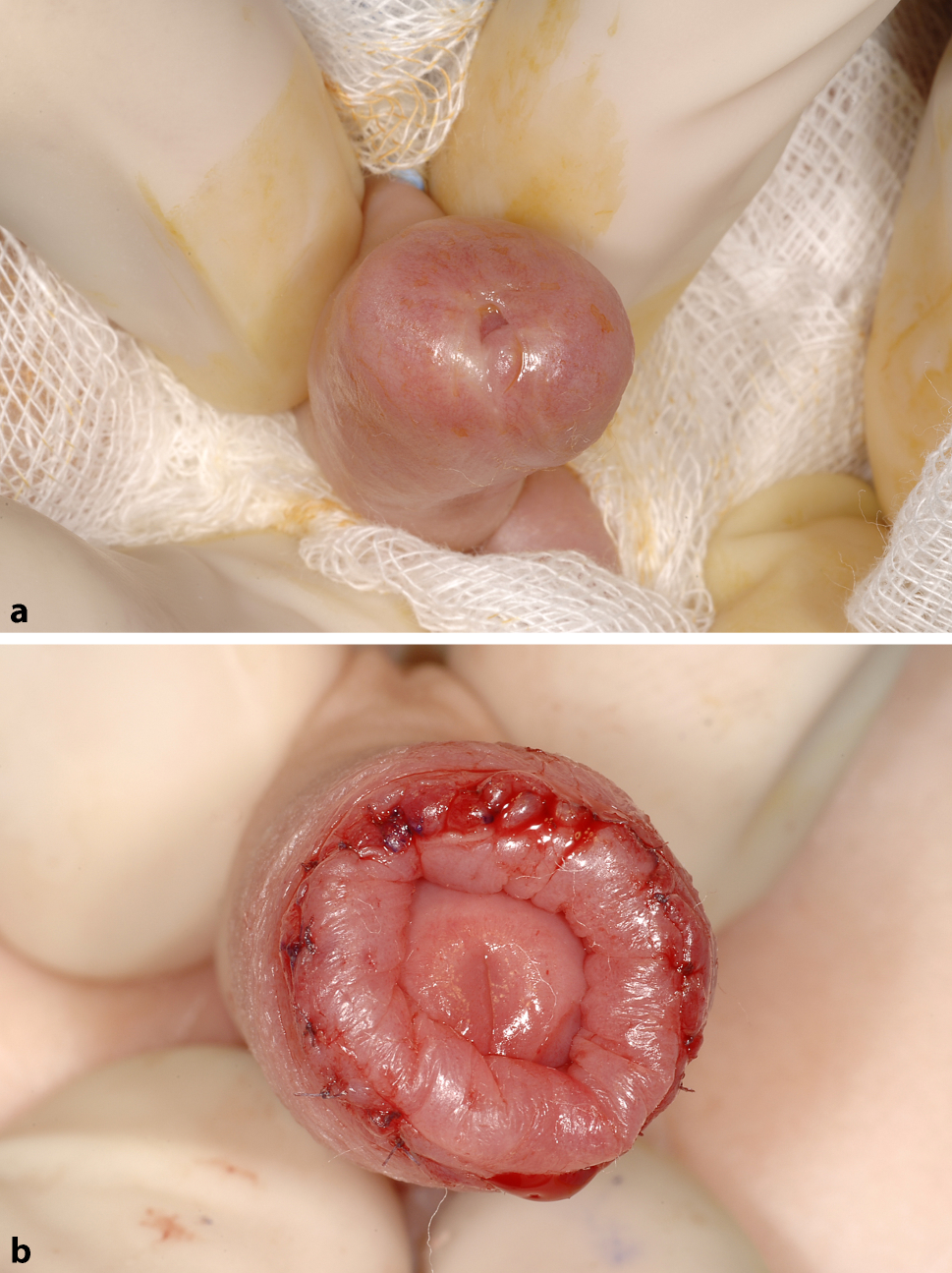 yo boy penis phimosis Retrospective analyses on preputioplasties in boys with pathological  phimosis performed over the last nine years | Tijdschrift voor Urologie