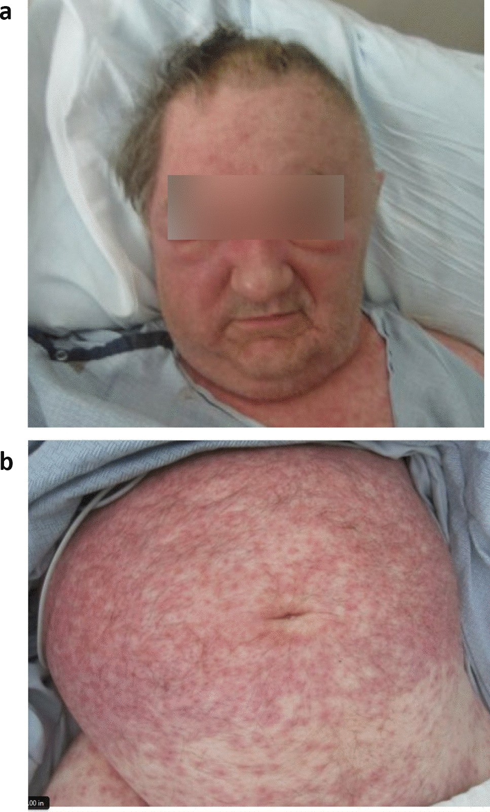 Updates and Insights in the Diagnosis and Management of DRESS Syndrome |  Current Dermatology Reports | Springer Nature Link